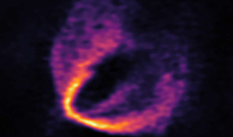 This image shows part of the ALMA data set at one wavelength and reveals a clear “kink” in the material, which indicates unambiguously the presence of one of the planets. Image: ESO, ALMA (ESO/NAOJ/NRAO); Pinte et al.
