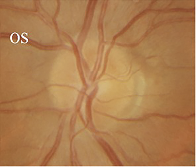 Fig.1 Optic disc oedema.