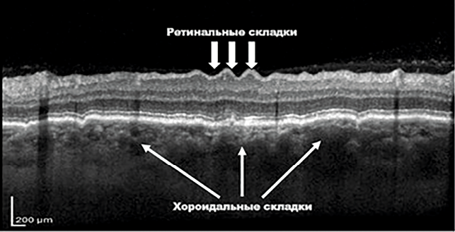 Fig.2 Chorioretinal folds on the astronaut’s optical coherence tomography after lengthy space mission