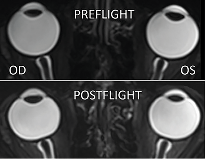 Fig.3 An astronaut’s preflight and postflight MRI.